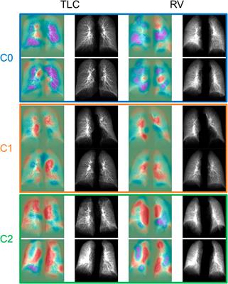 Contrastive learning and subtyping of post-COVID-19 lung computed tomography images